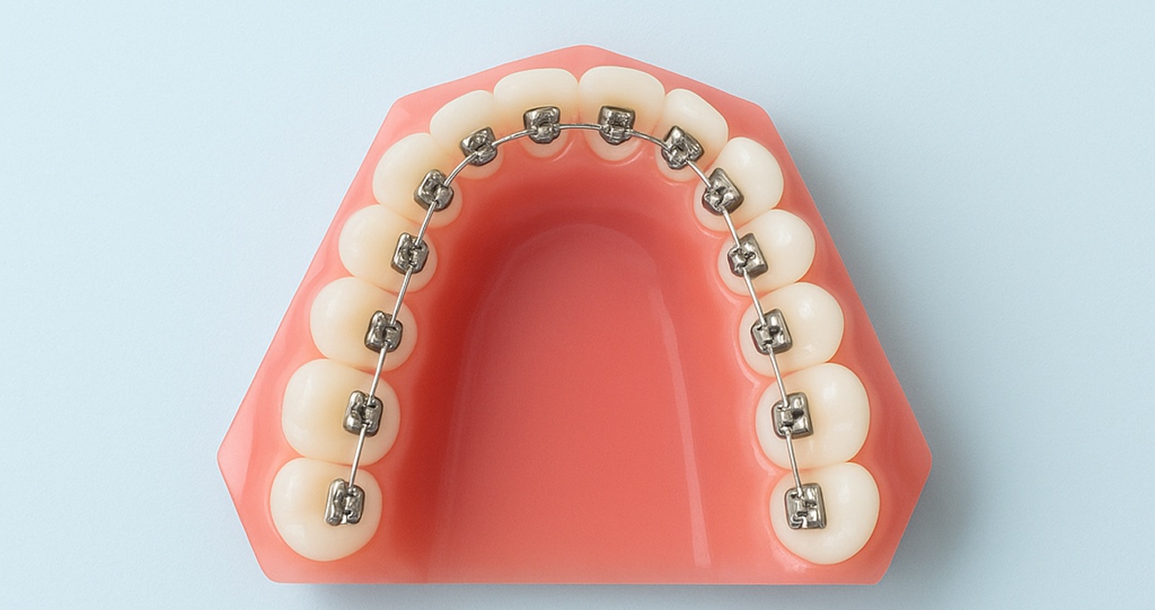 Lingual Braces
