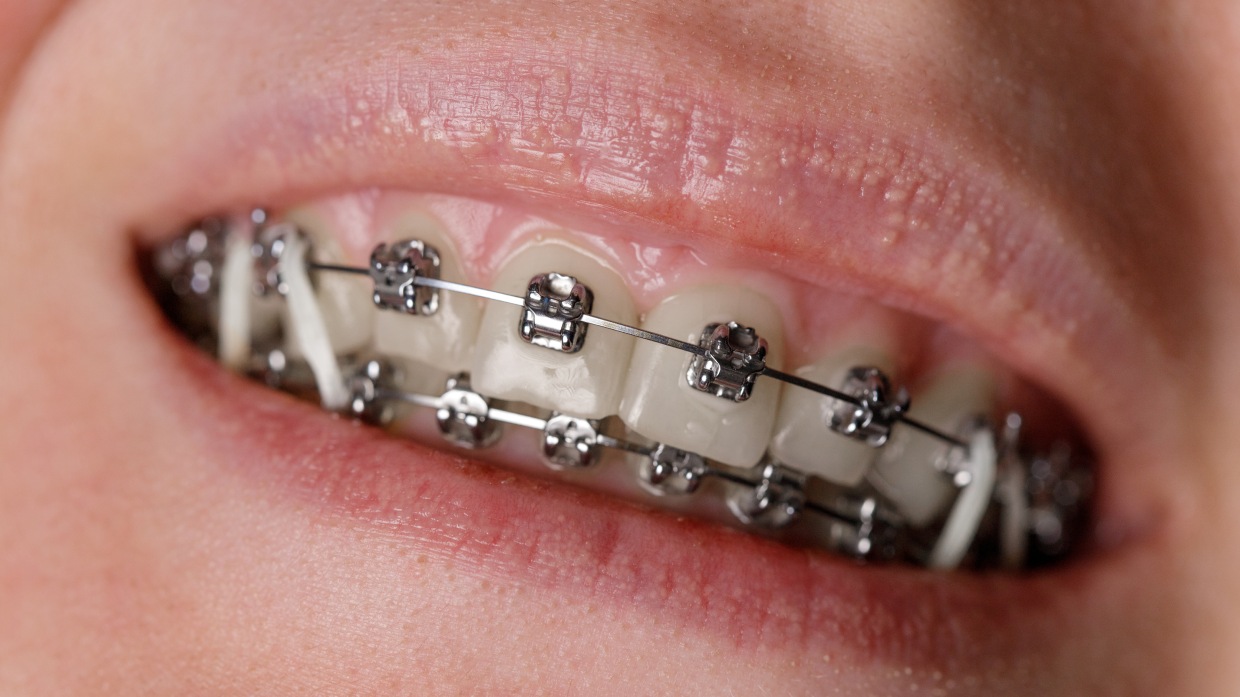 Self-Ligating Braces